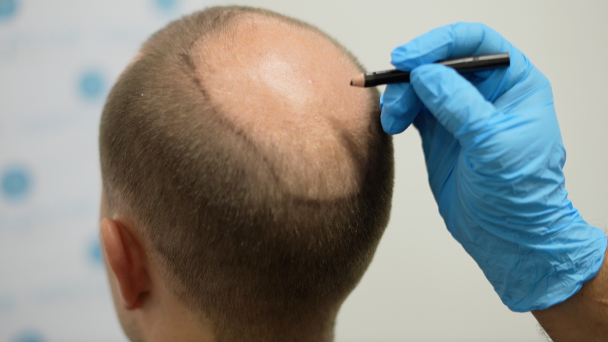Vorbereitung Haartransplantation – Medical Inn Hair Düsseldorf